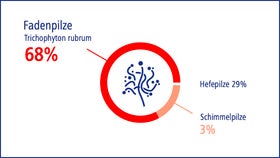 Dermatophyten sind die häufigsten Erreger für Nagelpilz